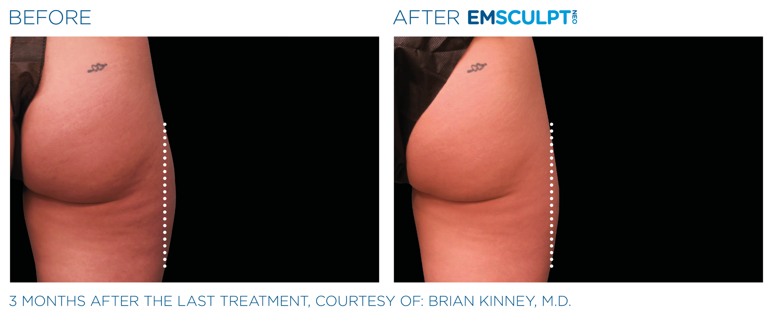 Emsculpt_neo_PIC_Ba-card-female-outer_thighs-093_ENUS100